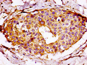 IHC image of CSB-PA020476LA01HU diluted at 1:100 and staining in paraffin-embedded human breast cancer performed on a Leica BondTM system. After dewaxing and hydration, antigen retrieval was mediated by high pressure in a citrate buffer (pH 6.0)....
