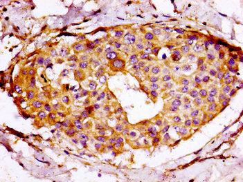 IHC image of CSB-PA020476LA01HU diluted at 1:100 and staining in paraffin-embedded human breast cancer performed on a Leica BondTM system. After dewaxing and hydration, antigen retrieval was mediated by high pressure in a citrate buffer (pH 6.0)....