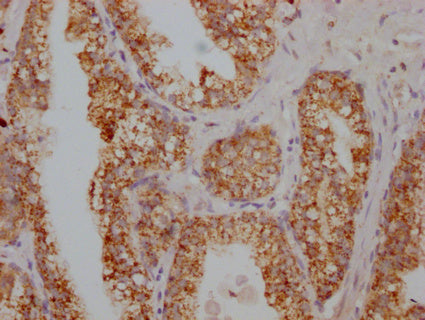 IHC image of CSB-PA020626HA01HU diluted at 1:100 and staining in paraffin-embedded human prostate cancer performed on a Leica BondTM system. After dewaxing and hydration, antigen retrieval was mediated by high pressure in a citrate buffer (pH 6.0)...