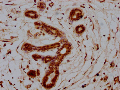IHC image of CSB-PA020635HA01HU diluted at 1:100 and staining in paraffin-embedded human breast cancer performed on a Leica BondTM system. After dewaxing and hydration, antigen retrieval was mediated by high pressure in a citrate buffer (pH 6.0)....