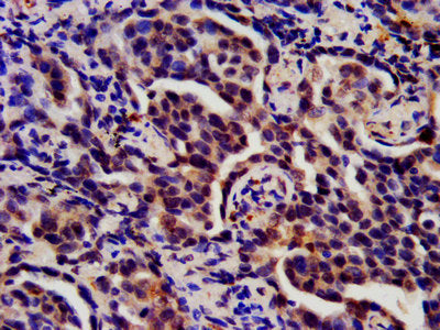 IHC image of CSB-PA020641HA01HU diluted at 1:200 and staining in paraffin-embedded human lung cancer performed on a Leica BondTM system. After dewaxing and hydration, antigen retrieval was mediated by high pressure in a citrate buffer (pH 6.0). Se...