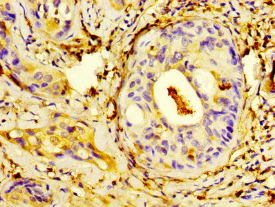 IHC image of CSB-PA020642HA01HU diluted at 1:400 and staining in paraffin-embedded human cervical cancer performed on a Leica BondTM system. After dewaxing and hydration, antigen retrieval was mediated by high pressure in a citrate buffer (pH 6.0)...