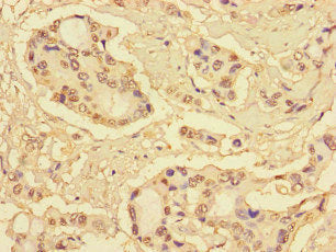 Immunohistochemistry of paraffin-embedded human pancreatic cancer using CSB-PA020645LA01HU at dilution of 1:100