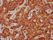 IHC image of CSB-PA020657LA01HU diluted at 1:600 and staining in paraffin-embedded human liver cancer performed on a Leica BondTM system. After dewaxing and hydration, antigen retrieval was mediated by high pressure in a citrate buffer (pH 6.0). S...