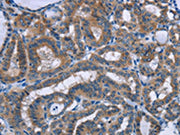 The image on the left is immunohistochemistry of paraffin-embedded Human thyroid cancer tissue using CSB-PA020661(PLIN1 Antibody) at dilution 1/30, on the right is treated with synthetic peptide. (Original magnification: ×200)
