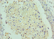 Immunohistochemistry of paraffin-embedded human cervical cancer using CSB-PA020695ESR2HU at dilution of 1:100