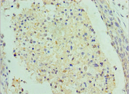 Immunohistochemistry of paraffin-embedded human cervical cancer using CSB-PA020695ESR2HU at dilution of 1:100