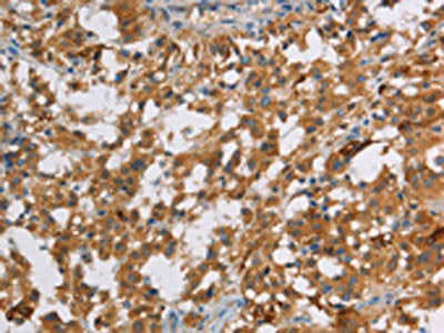 The image on the left is immunohistochemistry of paraffin-embedded Human thyroid cancer tissue using CSB-PA020742(DBH Antibody) at dilution 1/70, on the right is treated with fusion protein. (Original magnification: ×200)