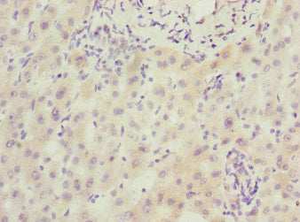 Immunohistochemistry of paraffin-embedded human liver cancer using CSB-PA020755DSR1HU at dilution of 1:100
