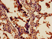 Immunohistochemistry of paraffin-embedded human lung cancer using CSB-PA020802LA01HU at dilution of 1:100