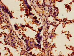 Immunohistochemistry of paraffin-embedded human lung cancer using CSB-PA020802LA01HU at dilution of 1:100