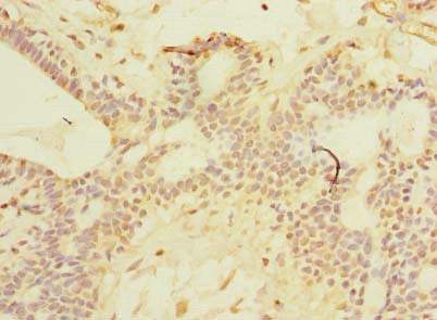Immunohistochemistry of paraffin-embedded human breast cancer using CSB-PA020847LA01HU at dilution of 1:100