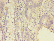Immunohistochemistry of paraffin-embedded human colon cancer using CSB-PA020851LA01HU at dilution of 1:100