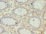 Immunohistochemistry of paraffin-embedded human colon cancer using CSB-PA020931LA01HU at dilution of 1:100