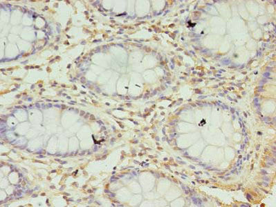 Immunohistochemistry of paraffin-embedded human colon cancer using CSB-PA020931LA01HU at dilution of 1:100
