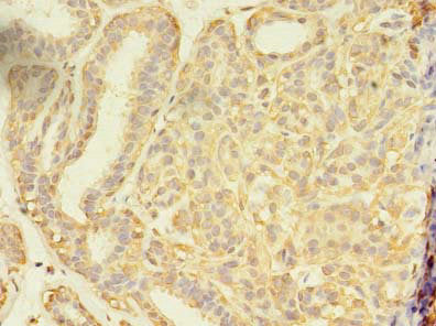 Immunohistochemistry of paraffin-embedded human breast cancer using CSB-PA020954LA01HU at dilution of 1:100
