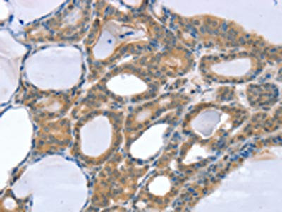 The image on the left is immunohistochemistry of paraffin-embedded Human thyroid cancer tissue using CSB-PA020995(SNX4 Antibody) at dilution 1/25, on the right is treated with fusion protein. (Original magnification: ×200)