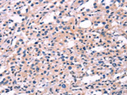 The image on the left is immunohistochemistry of paraffin-embedded Human thyroid cancer tissue using CSB-PA021005(FGF16 Antibody) at dilution 1/30, on the right is treated with synthetic peptide. (Original magnification: ×200)