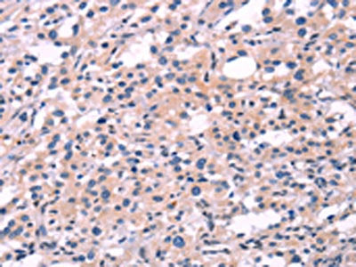The image on the left is immunohistochemistry of paraffin-embedded Human thyroid cancer tissue using CSB-PA021005(FGF16 Antibody) at dilution 1/30, on the right is treated with synthetic peptide. (Original magnification: ×200)