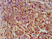 IHC image of CSB-PA021072LA01HU diluted at 1:600 and staining in paraffin-embedded human pancreatic cancer performed on a Leica BondTM system. After dewaxing and hydration, antigen retrieval was mediated by high pressure in a citrate buffer (pH 6....