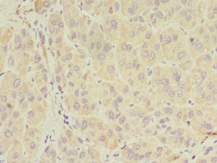 Immunohistochemistry of paraffin-embedded human liver cancer using CSB-PA021080ESR1HU at dilution of 1:100