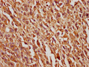IHC image of CSB-PA021084LA01HU diluted at 1:100 and staining in paraffin-embedded human melanoma cancer performed on a Leica BondTM system. After dewaxing and hydration, antigen retrieval was mediated by high pressure in a citrate buffer (pH 6.0)...