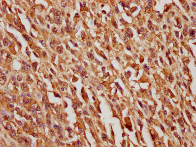 IHC image of CSB-PA021084LA01HU diluted at 1:100 and staining in paraffin-embedded human melanoma cancer performed on a Leica BondTM system. After dewaxing and hydration, antigen retrieval was mediated by high pressure in a citrate buffer (pH 6.0)...
