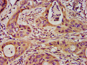 IHC image of CSB-PA021141LA01HU diluted at 1:200 and staining in paraffin-embedded human cervical cancer performed on a Leica BondTM system. After dewaxing and hydration, antigen retrieval was mediated by high pressure in a citrate buffer (pH 6.0)...