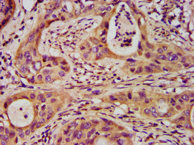 IHC image of CSB-PA021141LA01HU diluted at 1:200 and staining in paraffin-embedded human cervical cancer performed on a Leica BondTM system. After dewaxing and hydration, antigen retrieval was mediated by high pressure in a citrate buffer (pH 6.0)...