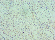 Immunohistochemistry of paraffin-embedded human breast cancer using CSB-PA021142ESR2HU at dilution of 1:100
