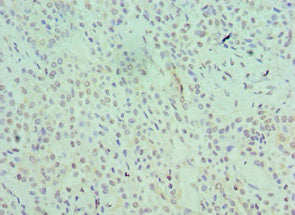 Immunohistochemistry of paraffin-embedded human breast cancer using CSB-PA021142ESR2HU at dilution of 1:100