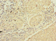 Immunohistochemistry of paraffin-embedded human lung cancer using CSB-PA021174LA01HU at dilution of 1:100
