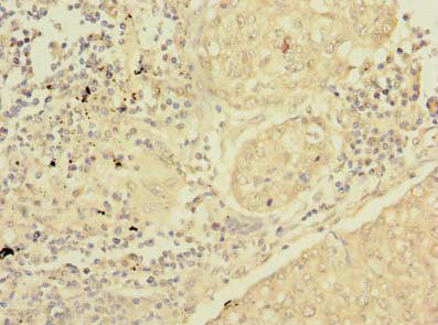 Immunohistochemistry of paraffin-embedded human lung cancer using CSB-PA021174LA01HU at dilution of 1:100