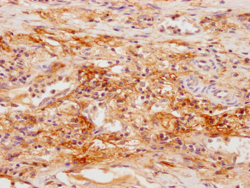 IHC image of CSB-PA021175NA01HU diluted at 1:100 and staining in paraffin-embedded human lung cancer performed on a Leica BondTM system. After dewaxing and hydration, antigen retrieval was mediated by high pressure in a citrate buffer (pH 6.0). Se...