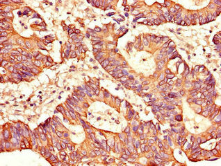 Immunohistochemistry of paraffin-embedded human colon cancer using CSB-PA021210LA01HU at dilution of 1:100