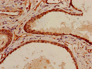 Immunohistochemistry of paraffin-embedded human prostate cancer using CSB-PA021253LA01HU at dilution of 1:100