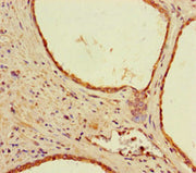 Immunohistochemistry of paraffin-embedded human prostate cancer using CSB-PA021263LA01HU at dilution of 1:100