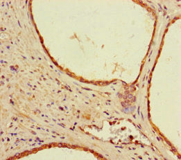 Immunohistochemistry of paraffin-embedded human prostate cancer using CSB-PA021263LA01HU at dilution of 1:100