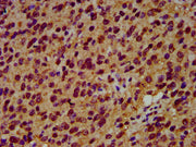 IHC image of CSB-PA021288LA01HU diluted at 1:600 and staining in paraffin-embedded human glioma performed on a Leica BondTM system. After dewaxing and hydration, antigen retrieval was mediated by high pressure in a citrate buffer (pH 6.0). Section...