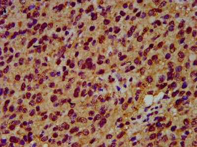 IHC image of CSB-PA021288LA01HU diluted at 1:600 and staining in paraffin-embedded human glioma performed on a Leica BondTM system. After dewaxing and hydration, antigen retrieval was mediated by high pressure in a citrate buffer (pH 6.0). Section...