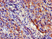 Immunohistochemistry of paraffin-embedded human liver cancer using CSB-PA021320LA01HU at dilution of 1:100