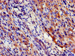 Immunohistochemistry of paraffin-embedded human liver cancer using CSB-PA021320LA01HU at dilution of 1:100