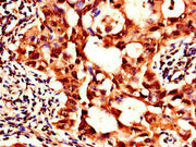 Immunohistochemistry of paraffin-embedded human lung cancer using CSB-PA021321LA01HU at dilution of 1:100