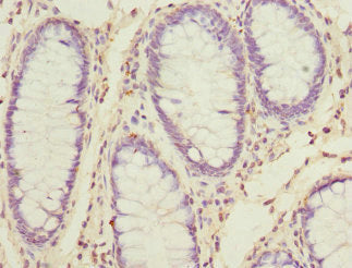 Immunohistochemistry of paraffin-embedded human colon cancer using CSB-PA021355DSR2HU at dilution of 1:100