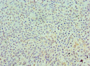 Immunohistochemistry of paraffin-embedded human breast cancer using CSB-PA021360ESR1HU at dilution of 1:100