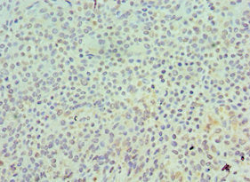 Immunohistochemistry of paraffin-embedded human breast cancer using CSB-PA021360ESR1HU at dilution of 1:100