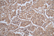 IHC image of CSB-PA021369ESR2HU diluted at 1:200 and staining in paraffin-embedded human lung cancer performed on a Leica BondTM system. After dewaxing and hydration, antigen retrieval was mediated by high pressure in a citrate buffer (pH 6.0). Se...