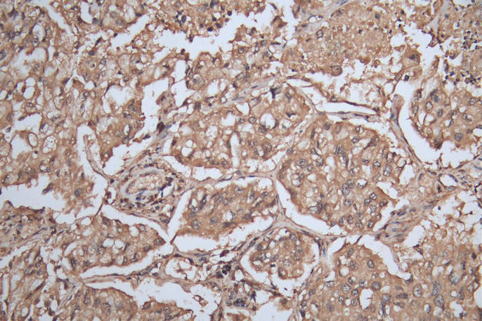 IHC image of CSB-PA021369ESR2HU diluted at 1:200 and staining in paraffin-embedded human lung cancer performed on a Leica BondTM system. After dewaxing and hydration, antigen retrieval was mediated by high pressure in a citrate buffer (pH 6.0). Se...