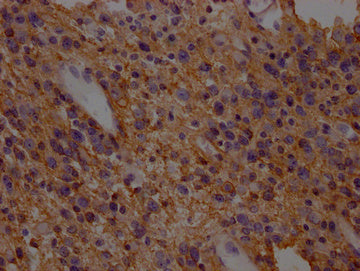 IHC image of CSB-PA021434LA01HU diluted at 1:200 and staining in paraffin-embedded human glioma cancer performed on a Leica BondTM system. After dewaxing and hydration, antigen retrieval was mediated by high pressure in a citrate buffer (pH 6.0)....