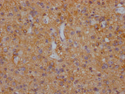 IHC image of CSB-PA021434LA11HU diluted at 1:200 and staining in paraffin-embedded human glioma cancer performed on a Leica BondTM system. After dewaxing and hydration, antigen retrieval was mediated by high pressure in a citrate buffer (pH 6.0)....